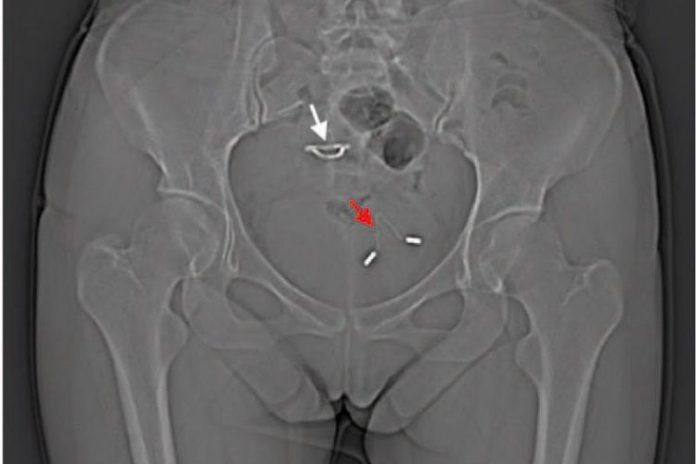Wei Chai; Wenlei Zhang; Guifeng Jia; Miao Cui; Lifeng Cui/CC BY-SA 4.0 An X-ray showing a womans displaced IUD in her bladder. The red arrow points to the IUD in the bladder, while the white arrow points to a second IUD inserted in the uterus